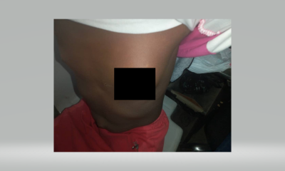 Father uses hot stone to stop daughter's breast from growing in Lagos